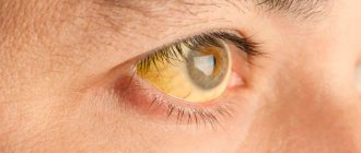 Causes of yellow sclera of the eyes