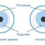 Зрение с астигматизмом